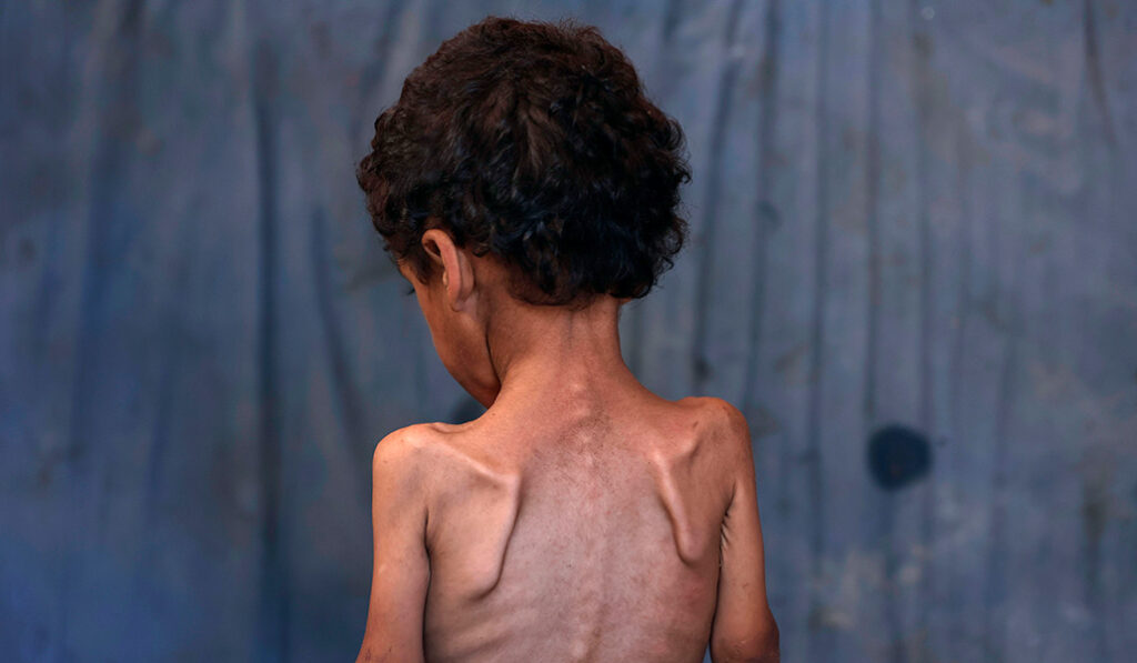 Yazan, niño gazatí de 2 años víctima del bloqueo de ayuda humanitaria.